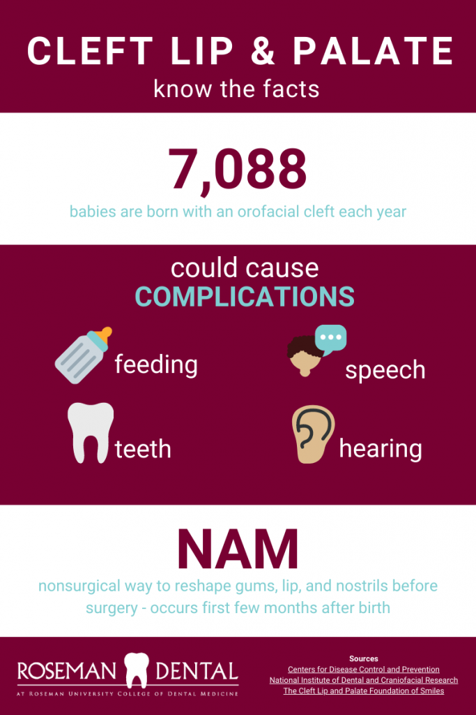 Graphic explaining facts on cleft lip and palate facts.