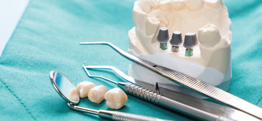 Which is better dentures or implants. Roseman Dental explains the differences between dentures and implants.