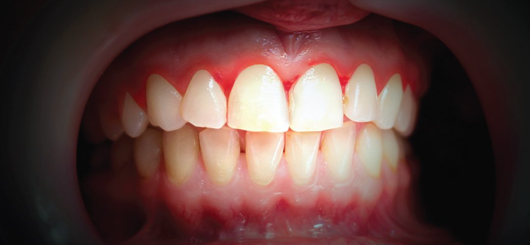 Why are my gums swollen?